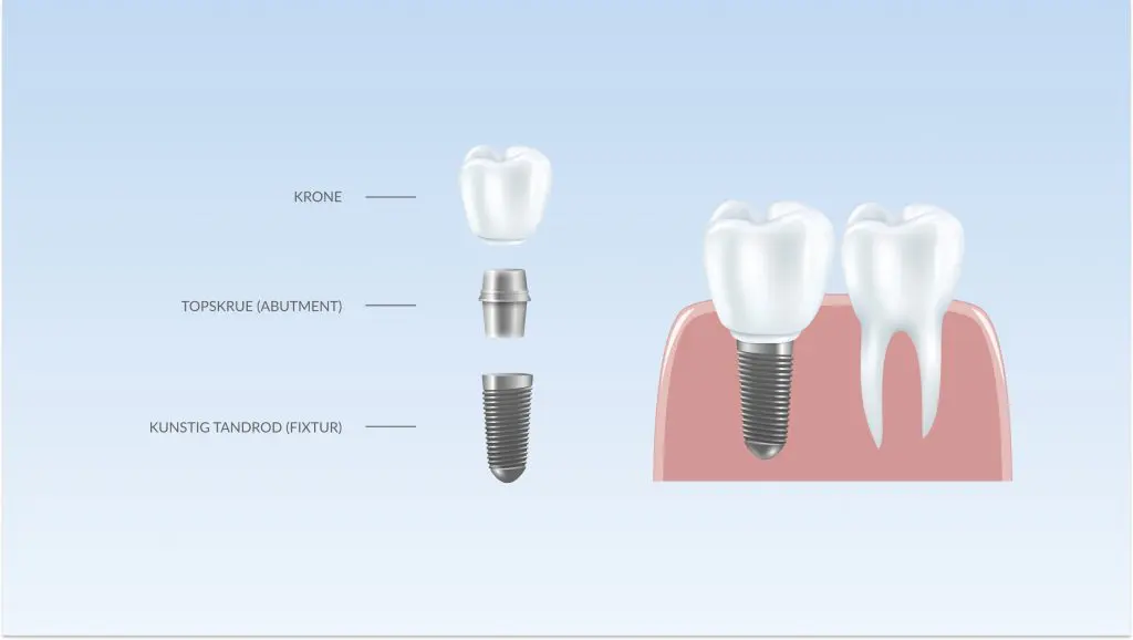 Illustration af et tandimplantats tre dele: krone, topskrue (abutment) og kunstig tandrod (fixtur)