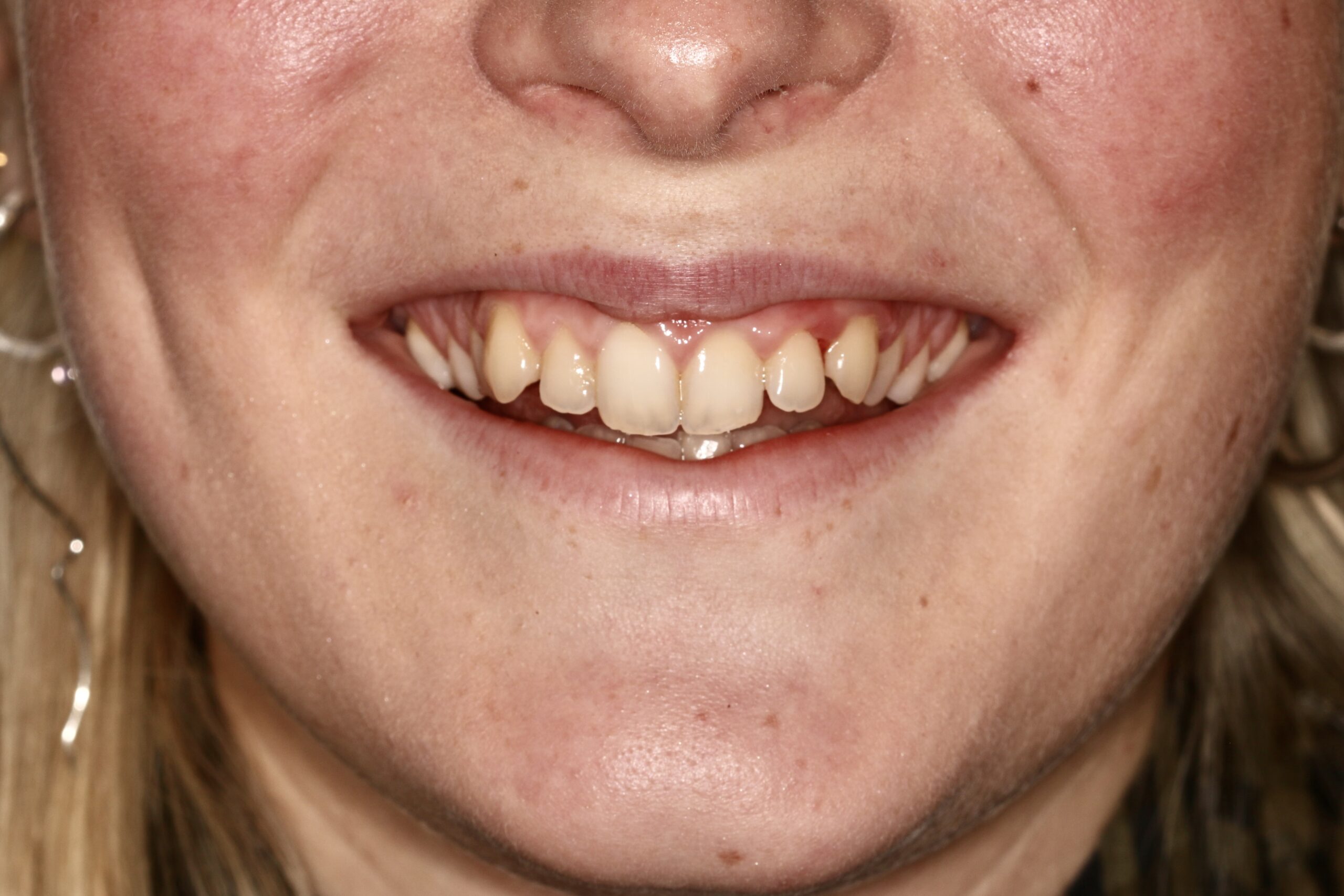 Före - Invisalign før og efter