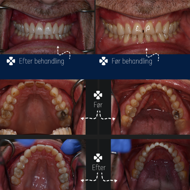 Tandblegning og genopbygning i plast viser før og efter behandling hos Colosseum Tandlægerne Herlev